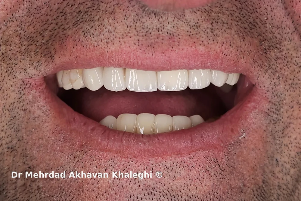 Featured clinical case image: Test Before Finalization