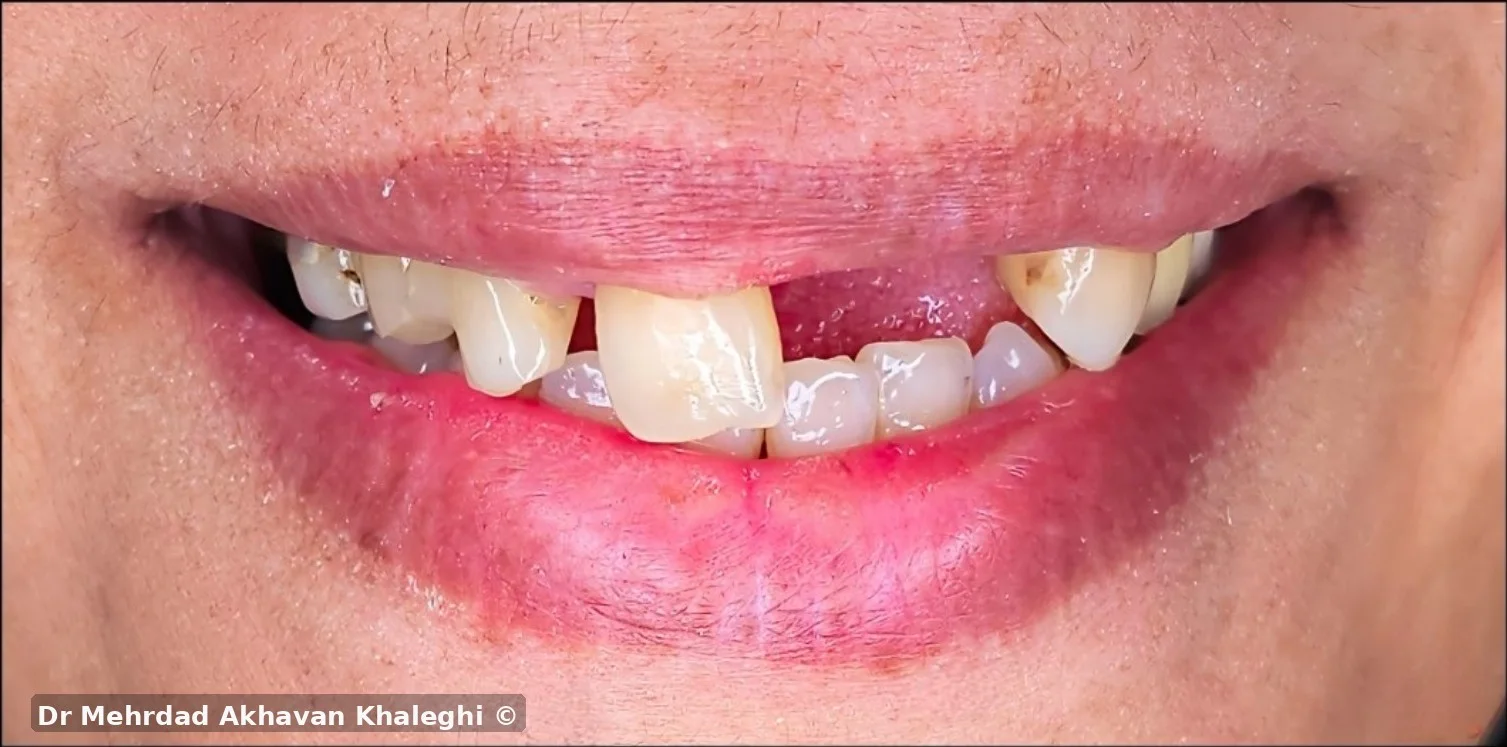 لبخند پس از خارجکردن دندانهای ۲۱ و ۲۲ و پیش از استفاده از پروتز موقت