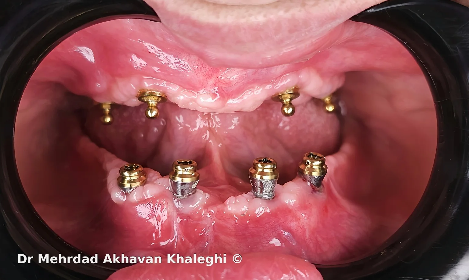 Ball attachmentهای فک بالا و Locatorهای فک پایین