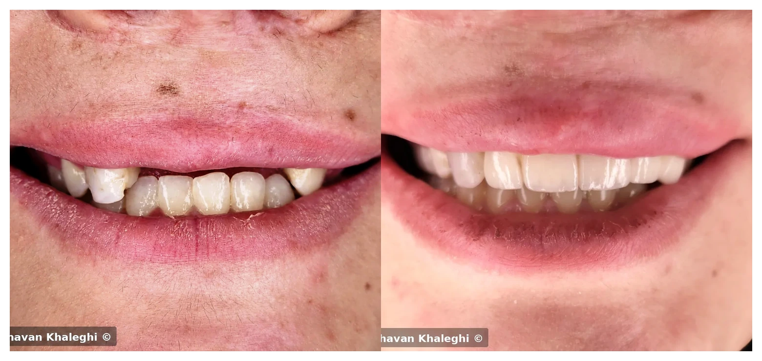 کلاژ مقایسه لبخند اولیه و لبخند نهایی