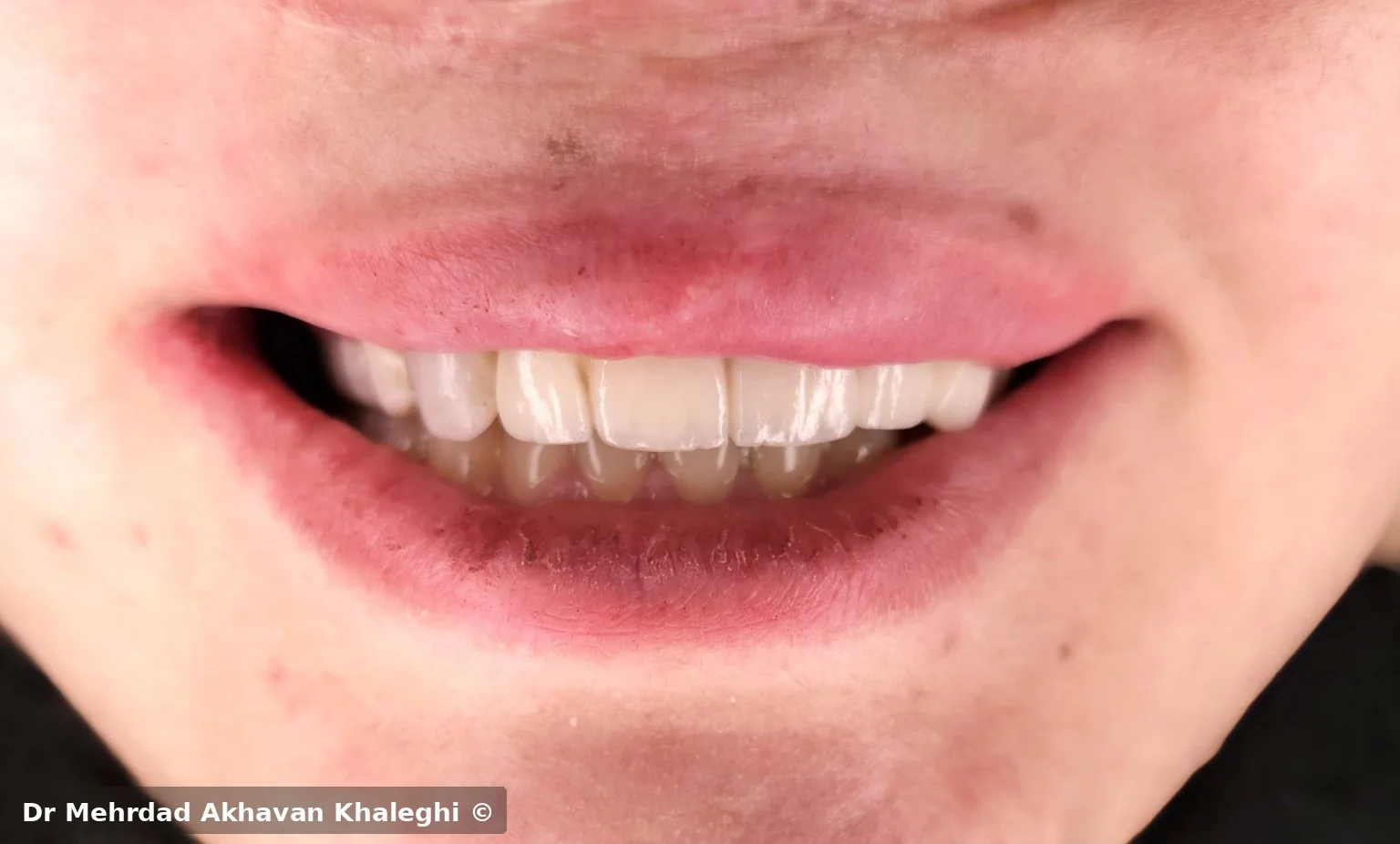 نمای لبخند نهایی در بازسازی ثابت بیمار cleft