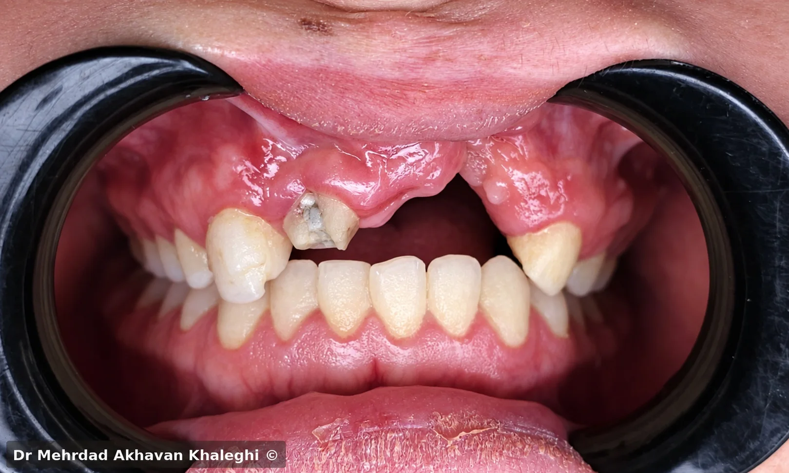 وضعیت اولیه داخلدهانی در ناحیه cleft