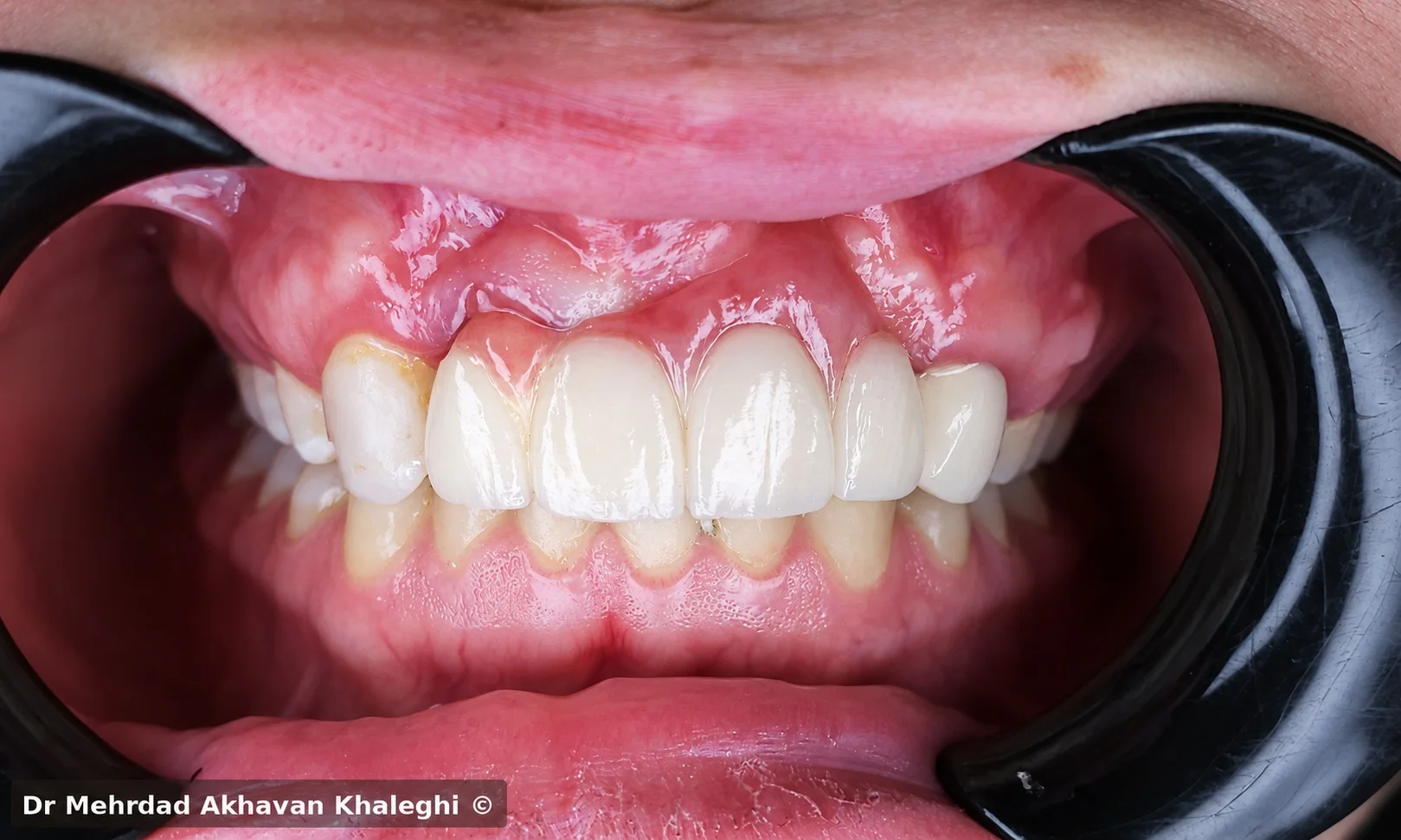 نمای نهایی داخلدهانی پس از بازسازی ثابت در بیمار cleft