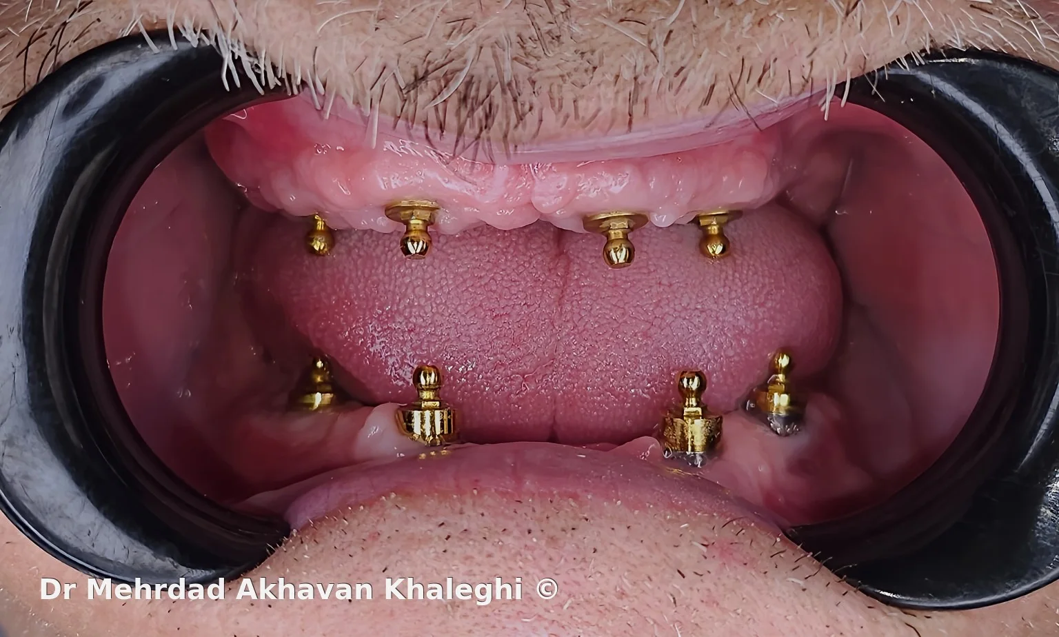 نمای داخل‌دهانی Ball Attachmentهای مستقل