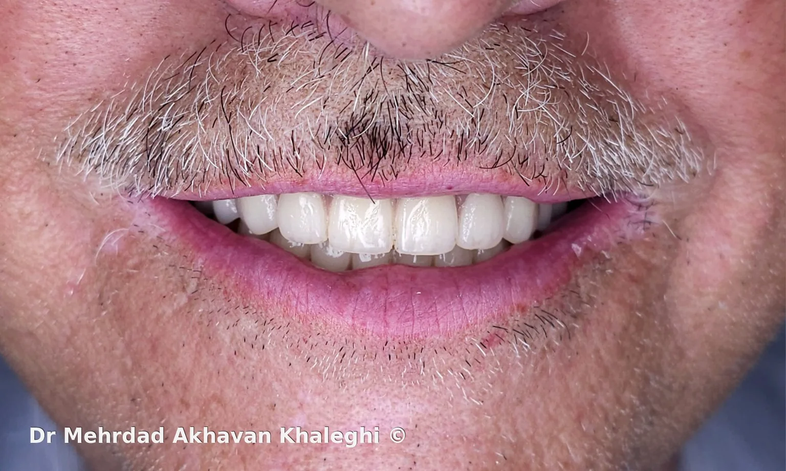 نمای لبخند نهایی
