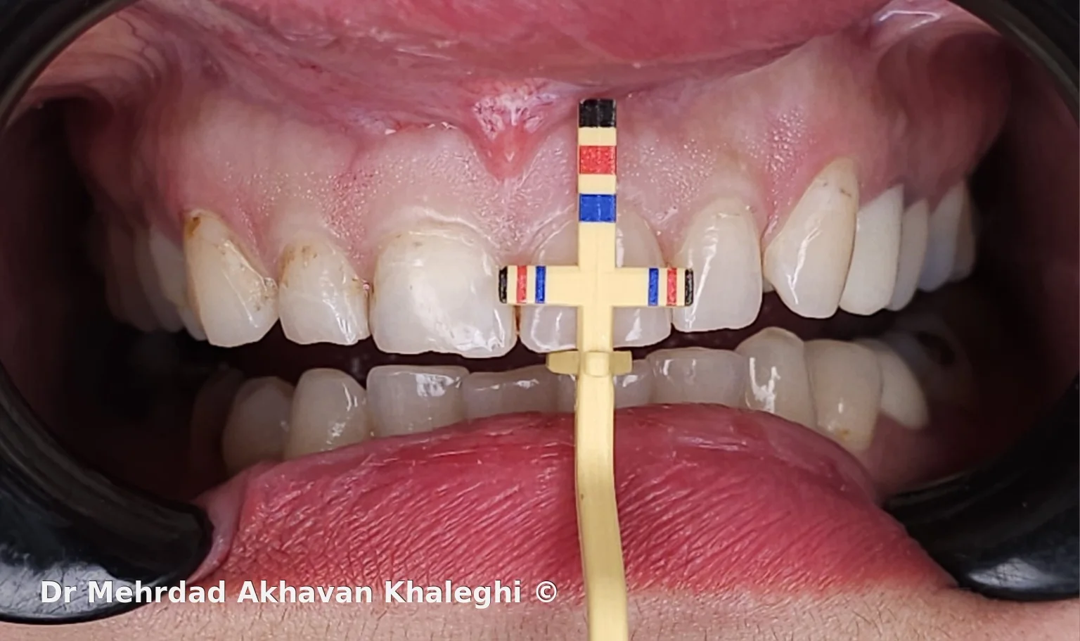 ارزیابی تناسبات دندانی و لثه‌ای با Chu Gauge