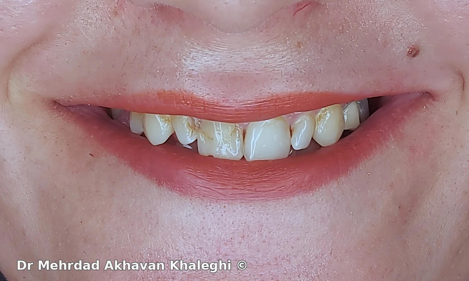 ناهماهنگی رنگ، فرم و تناسب دندانهای فک بالا پیش از درمان