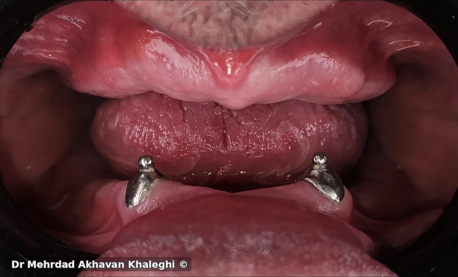 کانین‌های ۳۳ و ۴۳ پس از ریتریت و آماده‌سازی با post-ball attachment