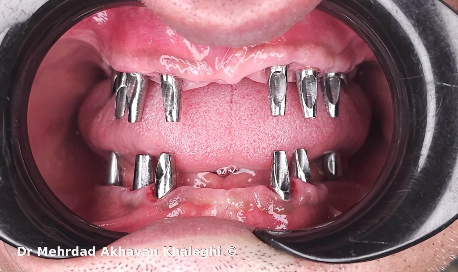Clinical view of prosthetic abutments in a full-arch implant rehabilitation