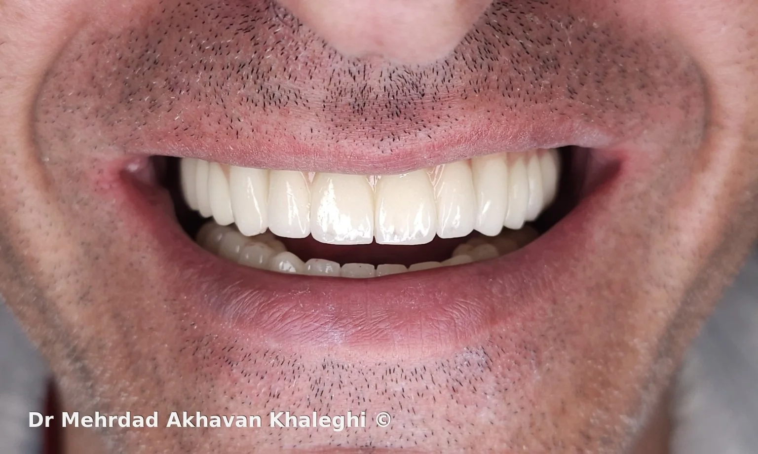 نمای خنده عمیق پس از بازسازی نهایی