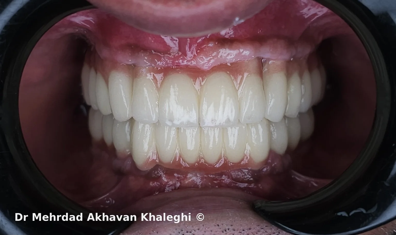 نمای تماسهای اکلوژنی از روبهرو