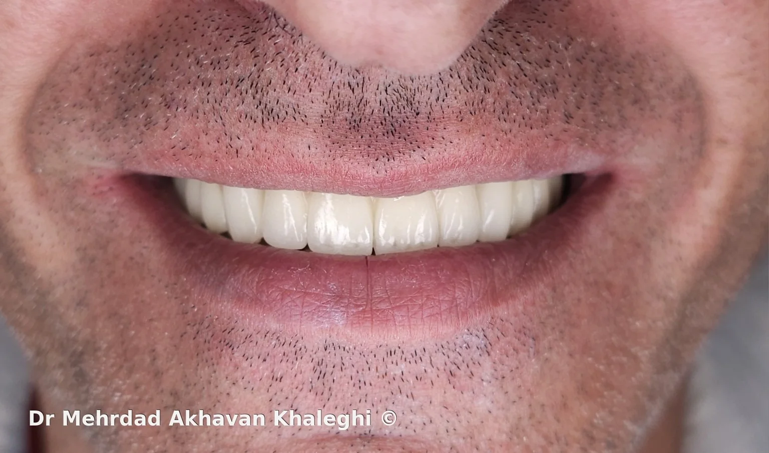 نمای خنده معمول از روبه‌رو پس از بازسازی ثابت تمام‌قوس