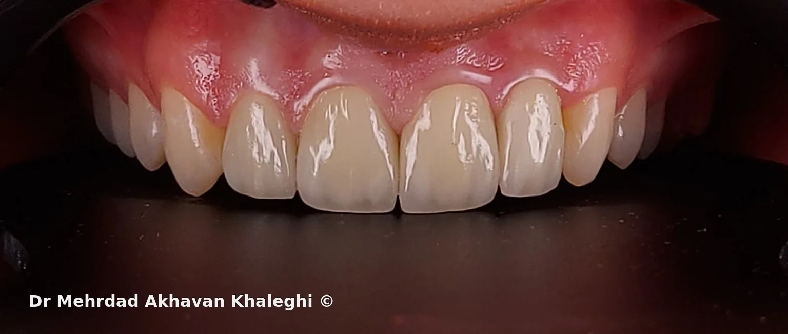 Definitive intraoral view of the four anterior crowns with the healthy canines preserved